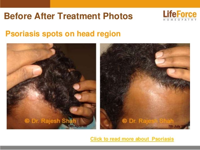 Psoriasis On Scalp And Head Photos Before After Treatment Pictures