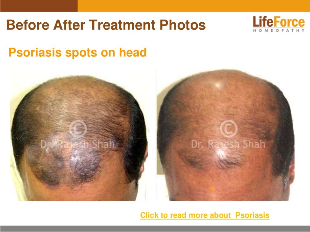 Psoriasis on Scalp & Head Photos Before After Treatment Pictures