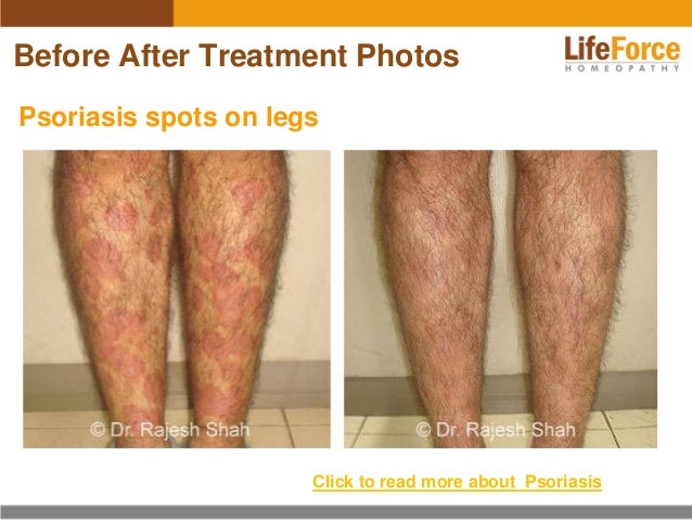 Psoriasis on Legs Photos Before After Treatment Pictures