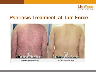 Psoriasis Treatment at Life Force

 