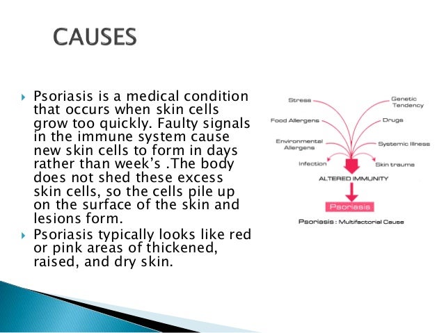 psoriasis treatment