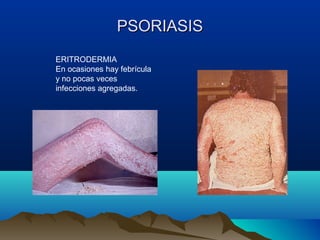 PSORIASISPSORIASIS
ERITRODERMIA
En ocasiones hay febrícula
y no pocas veces
infecciones agregadas.
 