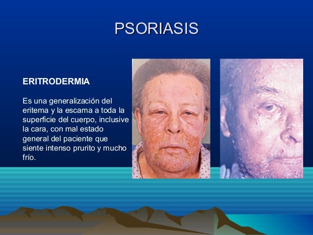 Psoriasis01