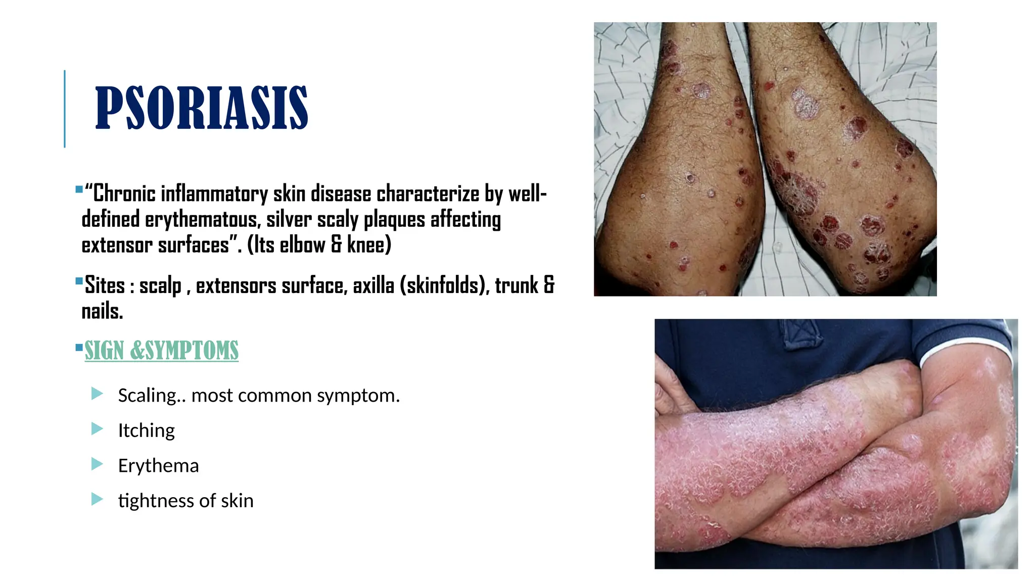 PSORIASIS dermatology slideshow by students | PPTX