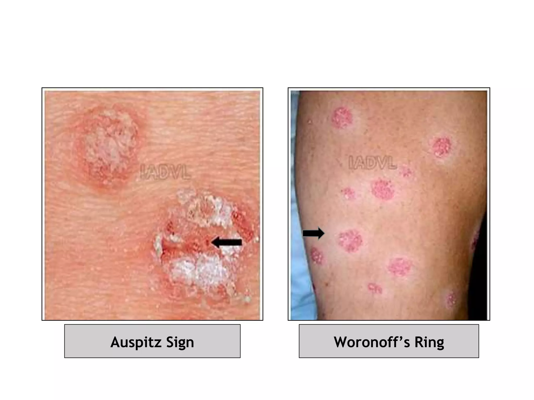 Auspitz Sign Woronoff’s Ring
 