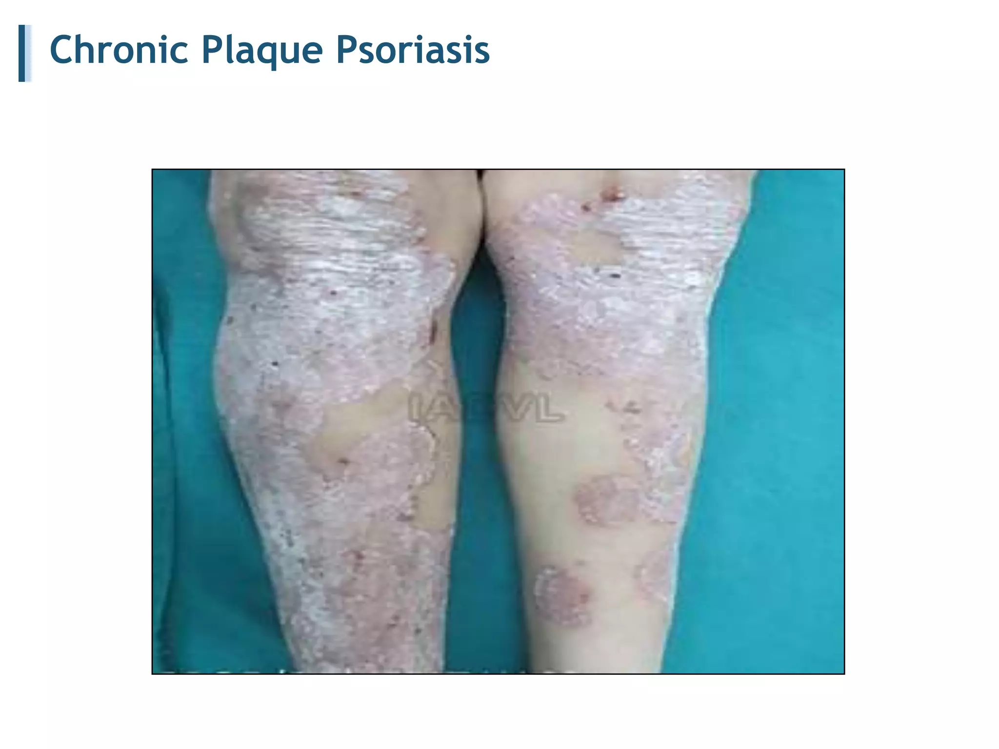 Chronic Plaque Psoriasis
 