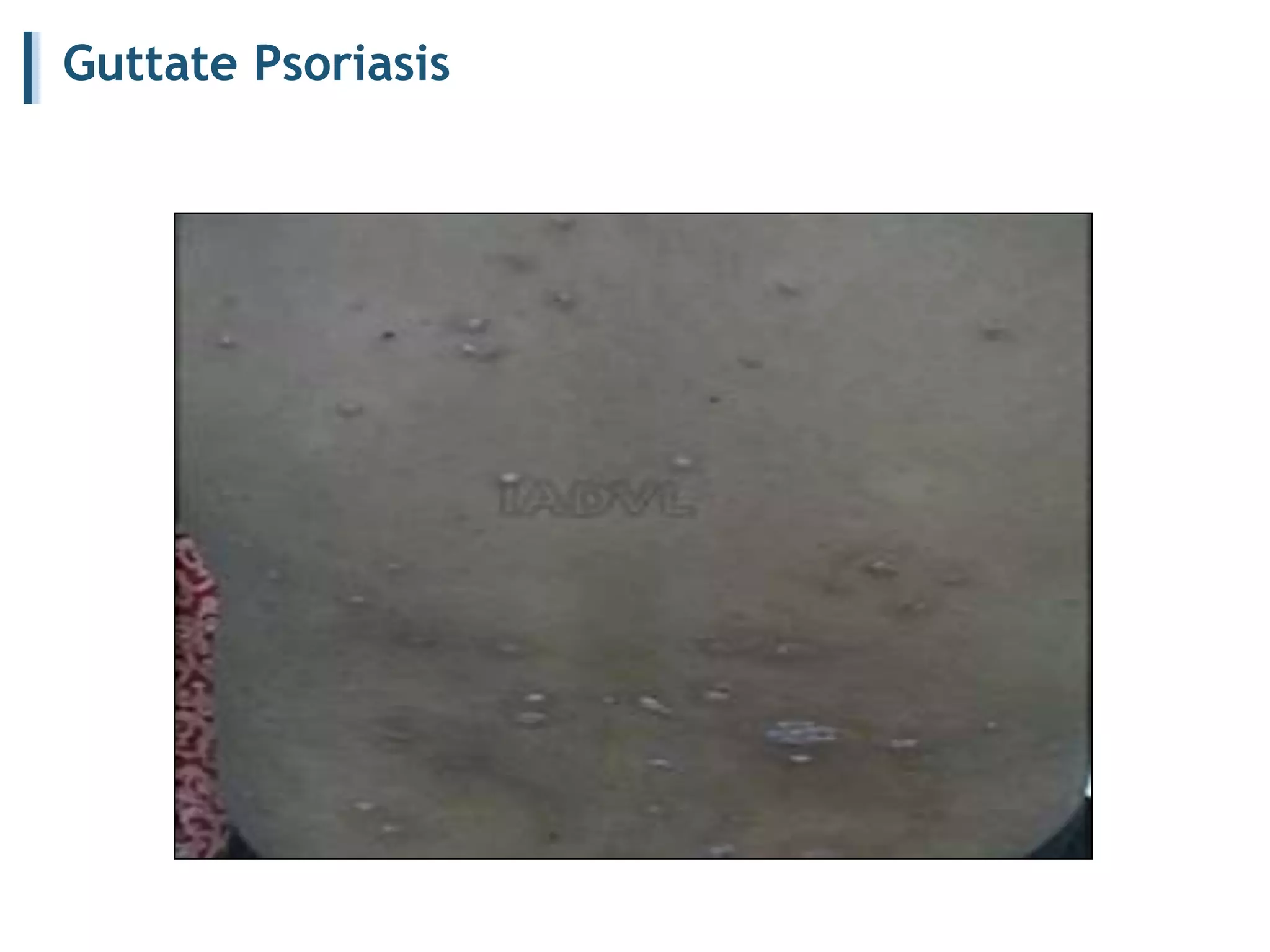 Guttate Psoriasis
 