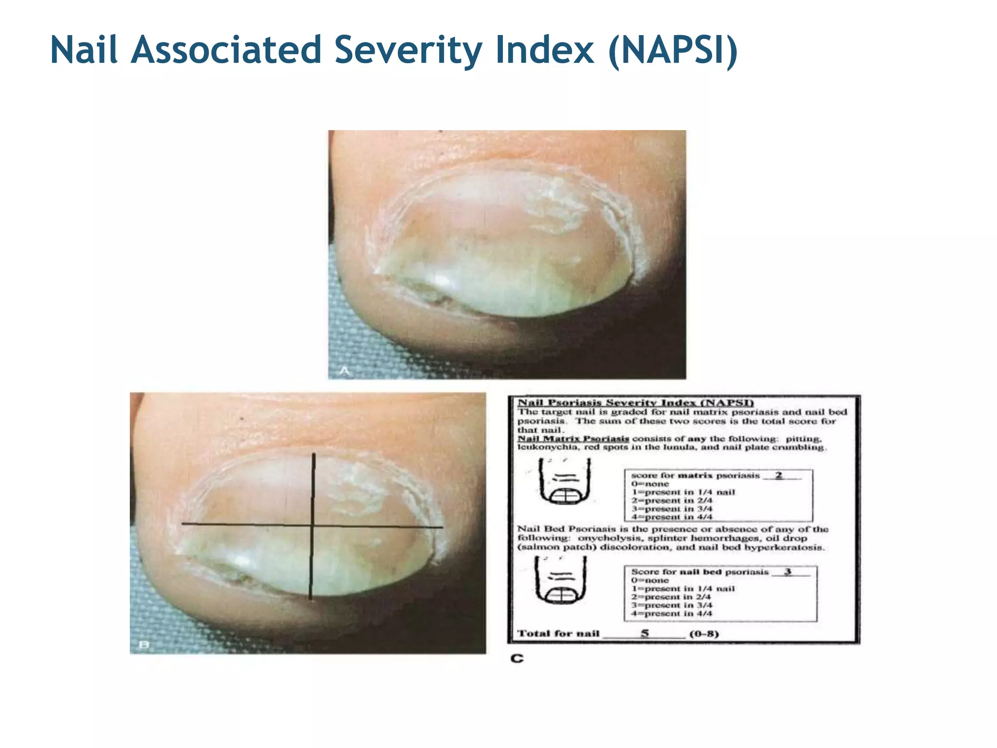Nail Associated Severity Index (NAPSI)
 