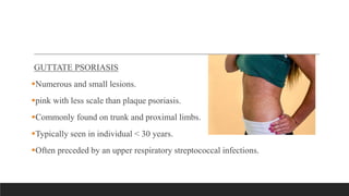 GUTTATE PSORIASIS
Numerous and small lesions.
pink with less scale than plaque psoriasis.
Commonly found on trunk and proximal limbs.
Typically seen in individual < 30 years.
Often preceded by an upper respiratory streptococcal infections.
 