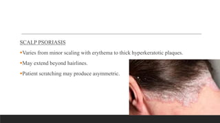 SCALP PSORIASIS
Varies from minor scaling with erythema to thick hyperkeratotic plaques.
May extend beyond hairlines.
Patient scratching may produce asymmetric.
 