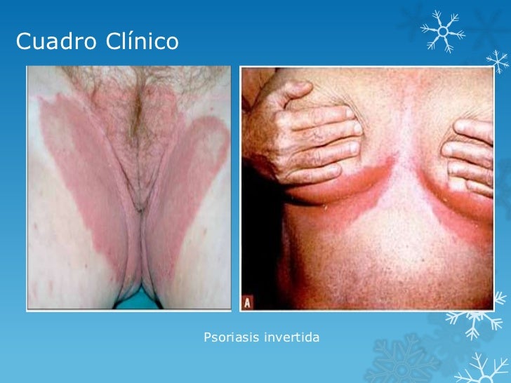 La psoriasis de la complicación a los ojos