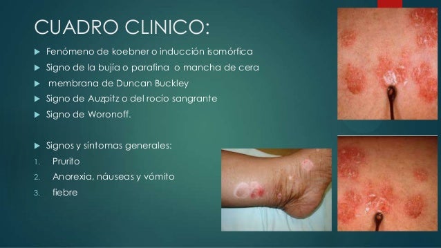 La eccema sobre los tobillos de los pies de la foto