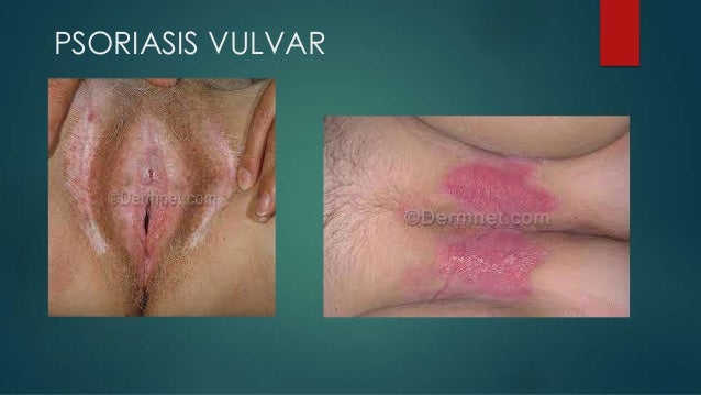 Psoriasis: oorzaken, psoriasis symptomen en behandeling