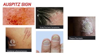 Psoriasis medicine guide and types pdf notes | PDF