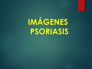 IMÁGENES
PSORIASIS
 