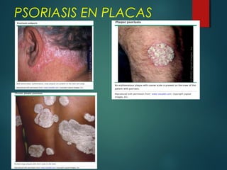 PSORIASIS EN PLACAS
 