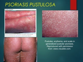 PSORIASIS PUSTULOSA
Pustules, erythema, and scale in
generalized pustular psoriasis.
Reproduced with permission
from: www.visualdx.com.
 