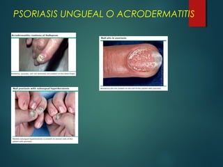 PSORIASIS UNGUEAL O ACRODERMATITIS
 