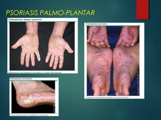 PSORIASIS PALMO-PLANTAR
 