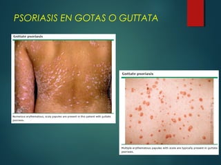 PSORIASIS EN GOTAS O GUTTATA
 
