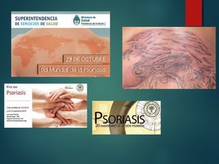 Psoriasis 250516