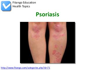 Fitango Education
          Health Topics

                              Psoriasis




http://www.fitango.com/categories.php?id=71
 
