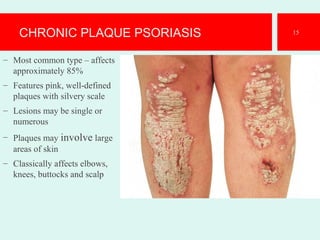 CHRONIC PLAQUE PSORIASIS
– Most common type – affects
approximately 85%
– Features pink, well-defined
plaques with silvery scale
– Lesions may be single or
numerous
– Plaques may involve large
areas of skin
– Classically affects elbows,
knees, buttocks and scalp
15
 