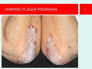 CHRONIC PLAQUE PSORIASIS 16
 