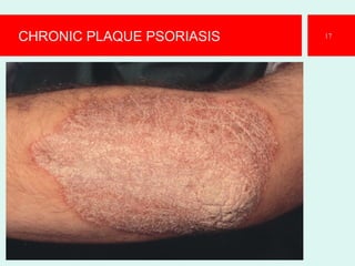 CHRONIC PLAQUE PSORIASIS 17
 