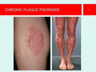 CHRONIC PLAQUE PSORIASIS 18
 