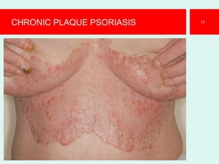 CHRONIC PLAQUE PSORIASIS 19
 