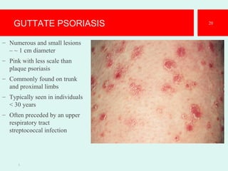 GUTTATE PSORIASIS
– Numerous and small lesions
– ~ 1 cm diameter
– Pink with less scale than
plaque psoriasis
– Commonly found on trunk
and proximal limbs
– Typically seen in individuals
< 30 years
– Often preceded by an upper
respiratory tract
streptococcal infection
1.
20
 