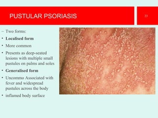 PUSTULAR PSORIASIS
– Two forms:
• Localised form
• More common
• Presents as deep-seated
lesions with multiple small
pustules on palms and soles
• Generalised form
• Uncommo Associated with
fever and widespread
pustules across the body
• inflamed body surface
23
 