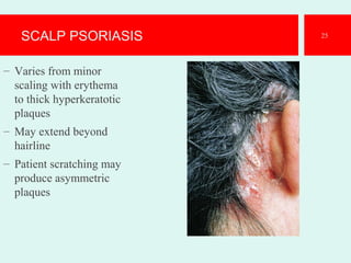 SCALP PSORIASIS
– Varies from minor
scaling with erythema
to thick hyperkeratotic
plaques
– May extend beyond
hairline
– Patient scratching may
produce asymmetric
plaques
25
 