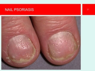 NAIL PSORIASIS 27
 
