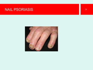 NAIL PSORIASIS 28
 