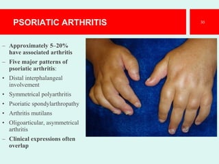 PSORIATIC ARTHRITIS
– Approximately 5–20%
have associated arthritis
– Five major patterns of
psoriatic arthritis:
• Distal interphalangeal
involvement
• Symmetrical polyarthritis
• Psoriatic spondylarthropathy
• Arthritis mutilans
• Oligoarticular, asymmetrical
arthritis
– Clinical expressions often
overlap
30
 