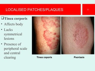 LOCALISED PATCHES/PLAQUES
Tinea corporis
• Affects body
• Lacks
symmetrical
lesions
• Presence of
peripheral scale
and central
clearing
.
33
Tinea coporis Psoriasis
 