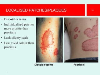 LOCALISED PATCHES/PLAQUES
– Discoid eczema
• Individualised patches
more pruritic than
psoriasis
• Lack silvery scale
• Less vivid colour than
psoriasis
1.
34
Discoid eczema Psoriasis
 