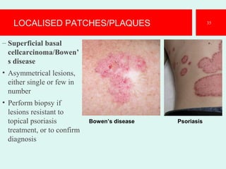 LOCALISED PATCHES/PLAQUES
– Superficial basal
cellcarcinoma/Bowen’
s disease
• Asymmetrical lesions,
either single or few in
number
• Perform biopsy if
lesions resistant to
topical psoriasis
treatment, or to confirm
diagnosis
35
Bowen’s disease Psoriasis
 