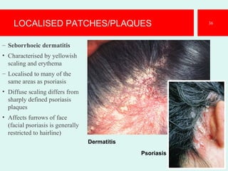 LOCALISED PATCHES/PLAQUES
– Seborrhoeic dermatitis
• Characterised by yellowish
scaling and erythema
– Localised to many of the
same areas as psoriasis
• Diffuse scaling differs from
sharply defined psoriasis
plaques
• Affects furrows of face
(facial psoriasis is generally
restricted to hairline)
36
Dermatitis
Psoriasis
 