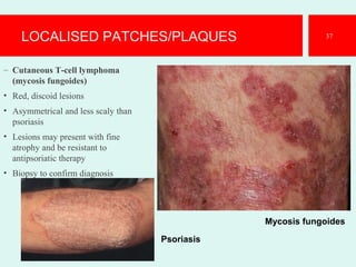 LOCALISED PATCHES/PLAQUES
– Cutaneous T-cell lymphoma
(mycosis fungoides)
• Red, discoid lesions
• Asymmetrical and less scaly than
psoriasis
• Lesions may present with fine
atrophy and be resistant to
antipsoriatic therapy
• Biopsy to confirm diagnosis
37
Mycosis fungoides
Psoriasis
 