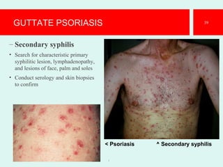 GUTTATE PSORIASIS
– Secondary syphilis
• Search for characteristic primary
syphilitic lesion, lymphadenopathy,
and lesions of face, palm and soles
• Conduct serology and skin biopsies
to confirm
1
39
< Psoriasis ^ Secondary syphilis
 