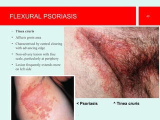 FLEXURAL PSORIASIS
– Tinea cruris
• Affects groin area
• Characterised by central clearing
with advancing edge
• Non-silvery lesion with fine
scale, particularly at periphery
• Lesion frequently extends more
on left side
1
40
< Psoriasis ^ Tinea cruris
 
