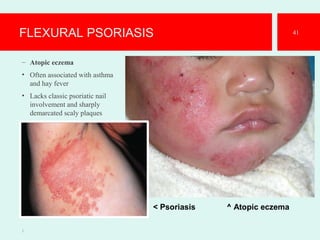 FLEXURAL PSORIASIS
– Atopic eczema
• Often associated with asthma
and hay fever
• Lacks classic psoriatic nail
involvement and sharply
demarcated scaly plaques
1.
41
< Psoriasis ^ Atopic eczema
 