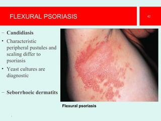 FLEXURAL PSORIASIS
– Candidiasis
• Characteristic
peripheral pustules and
scaling differ to
psoriasis
• Yeast cultures are
diagnostic
– Seborrhoeic dermatits
1
42
Flexural psoriasis
 