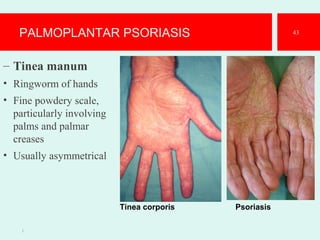 PALMOPLANTAR PSORIASIS
– Tinea manum
• Ringworm of hands
• Fine powdery scale,
particularly involving
palms and palmar
creases
• Usually asymmetrical
1.
43
Tinea corporis Psoriasis
 