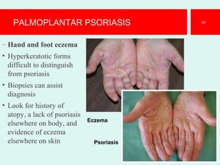 PALMOPLANTAR PSORIASIS
– Hand and foot eczema
• Hyperkeratotic forms
difficult to distinguish
from psoriasis
• Biopsies can assist
diagnosis
• Look for history of
atopy, a lack of psoriasis
elsewhere on body, and
evidence of eczema
elsewhere on skin
44
Eczema
Psoriasis
 