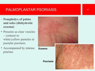 PALMOPLANTAR PSORIASIS
– Pompholyx of palms
and soles (dishydrotic
eczema)
• Presents as clear vesicles
– contrast to
white/yellow pustules in
pustular psoriasis
• Accompanied by intense
pruritus
45
Eczema
Psoriasis
 