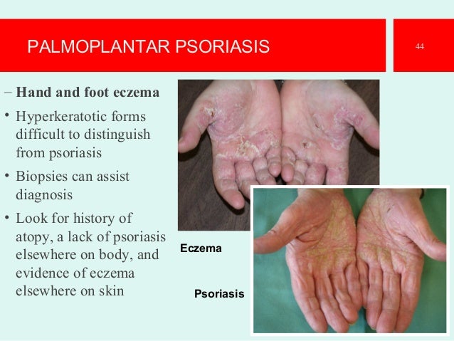 Psoriasis The Best Presentation
